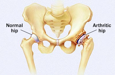 Hip Arthritis Symptoms 