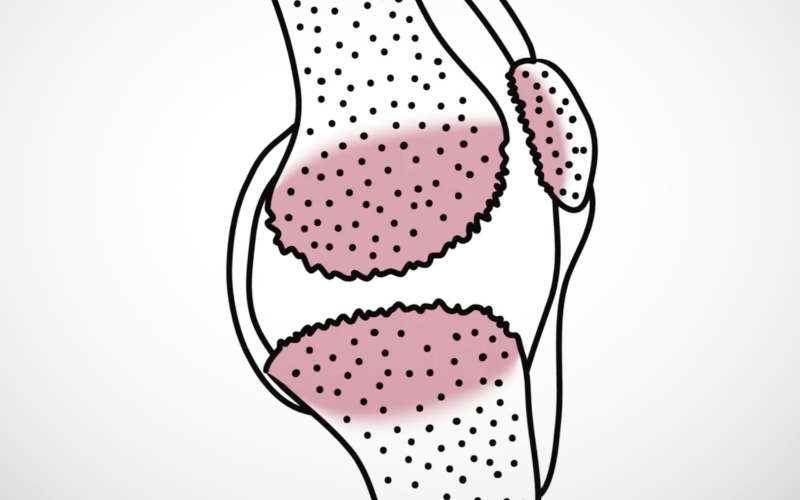 Knee Joint Arthritis