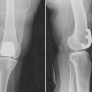 Patellofemoral Arthritis