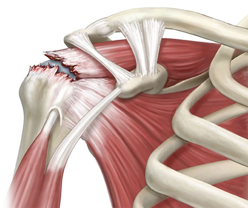 Shoulder Joint tear