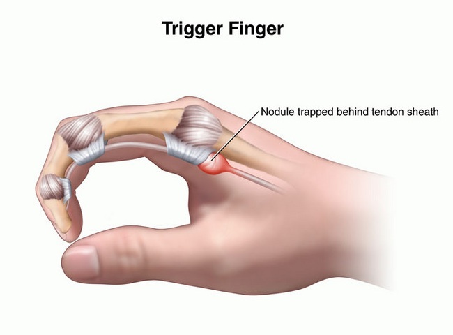 Trigger-finger